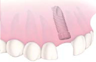 Mise en place de l'implant