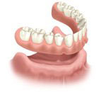 La prothèse dentaire totale