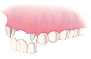 plusieurs dents manquants