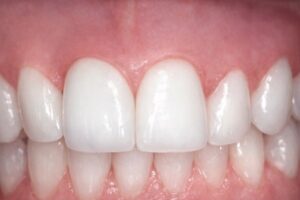 implant dentaire d'une dent