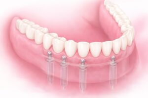 implant dentaire, cabinet ben abdallah