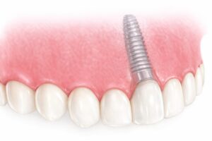 remplacement de dent