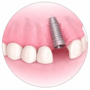 implant dentaire