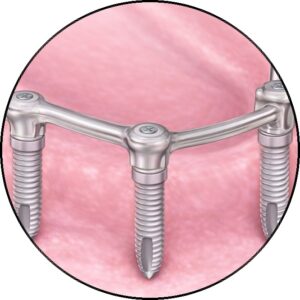 restauration total des dents